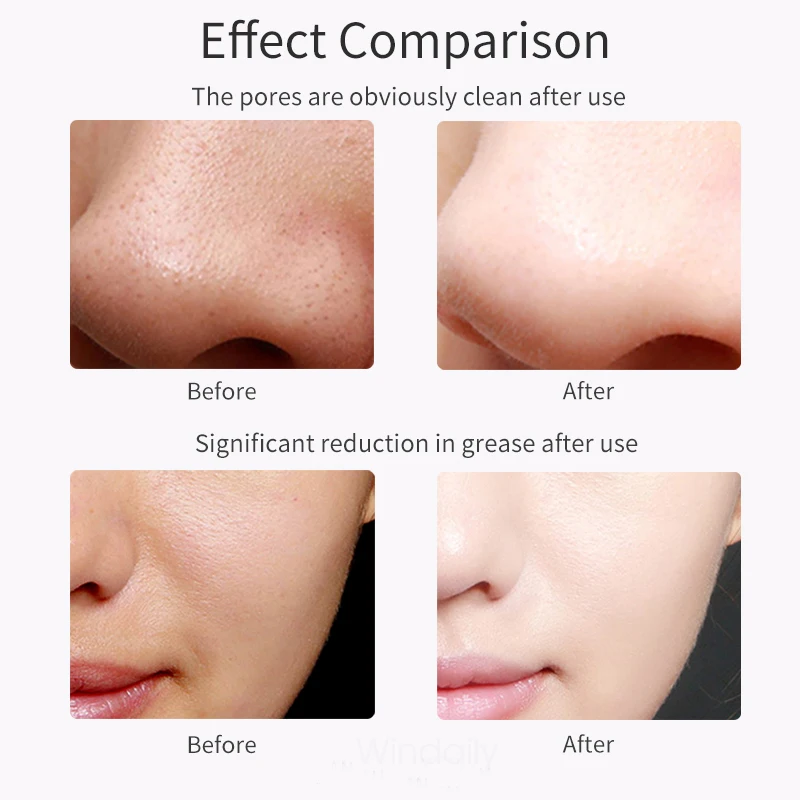 Healthy Beauty™ Ultrasonic Blackhead Skin Scrubber