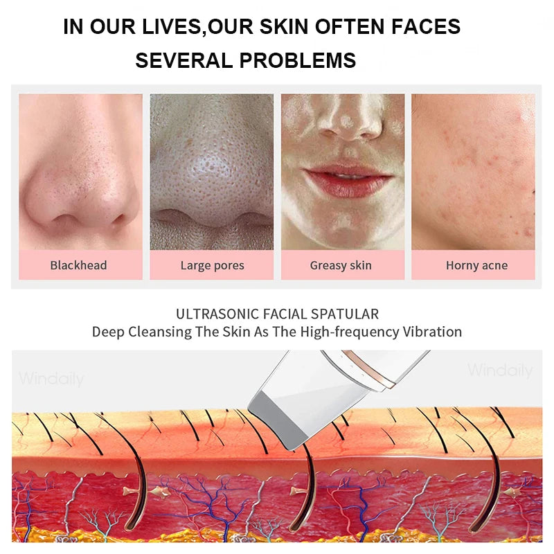Healthy Beauty™ Ultrasonic Blackhead Skin Scrubber