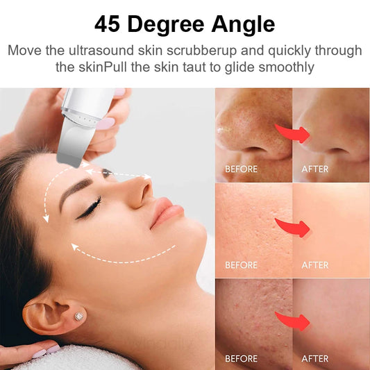 Healthy Beauty™ Ultrasonic Blackhead Skin Scrubber